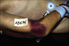 1. What type of hemorrhage is pictured here and what size do we normally see it in?

2. What makes the blue-green color of this bruise?

3. What makes a bruise yellow/brown?