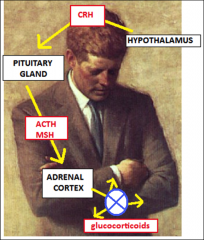 1. Adrenal Insufficiency - Autoimmune (90%) destroys all zones of the adrenal cortex

2. Weakness, Fatigue, Weight Loss, Low BP, Low Glucose, Hyperpigmentation (Increased ACTH and MSH), Decreased Pubic Hair (women)

3a. 90% - High K+, Metabolic Acidos