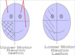 1. Loss of innervation below the eyes.

2. Loss of muscles of the contralateral side of the face