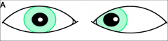 Diplopia, Medial Strabismus (eye adduciton)