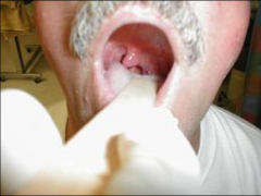 Tachycardia (unopposed Sympathetics)
Hoarseness (recurrent Laryngeal nerve damage)
Deviated Uvula - towards affected side
Difficulty Swallowing