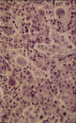 What are the multinucleated cells in this respiratory viral infection called?