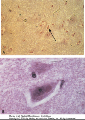 What type of CPE is depicted above?
What disease is this associated with?