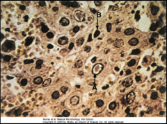 1. Cowdry Type A bodies

2. Herpes Simplex Virus (HSV). They are acidophilic intranuclear inclusion bodies 

3. Liver - Tzanck Smear of Vesicle Base