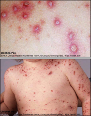 1. What is pictured here and what causes it?
2. What differentiates this from Small Pox?
3. Where is this virus latent?