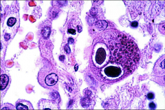 1. What CPE is this and what causes it?
2. How can primary infection be differentiated from recurrent/chronic infection?