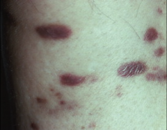 1. What is depicted above and what causes it?
2. What patient population is susceptible to this?