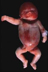 1. What virus causes this and what are the possibilities that caused this outcome?
2. How does a fetus get this virus?