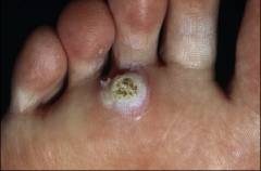 1. What is this and what virus causes it?
2. What histological feature causes this feature?
3. How long does it take for this to develop?
4. What serotype is common on the hands and feet? Plantar?