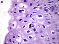 1. Pap smear - HPV
2. Koilocytes
3. Clumped, Rounded Keratinocytes (squamous) with clear halos around shrunken nuclei and a vacuolated cytoplasm.