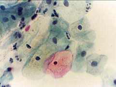 1. This is a pap smear: What is the diagnosis?
