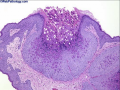 1. Wart from Molluscum Contagiosum
2. Eosinophilic cytoplasmic inclusion bodies. Dimple in the center of the wart
3. Cryotherapy - Virus is limited to the dermis