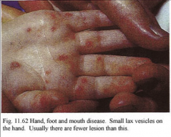 1. What disease is this and what causes it?
2. What is the morphology of this virus?