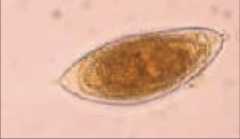 1. Trematode - Schistosome - Blood Fluke - Schistosoma Haematobium Egg
2. S. Haematobium Eggs have terminal spines
3. Venous Plexus - Urinary Bladder and Ureters
4. Granulomatous reaction
