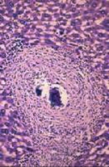 1. Granulomatous reaction - T-cells, Macs, Eosinophils - Eosinophilia, Microascess

2a. Katayama Fever

2b. Initial Schistosomulae larva release