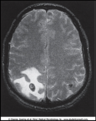 1. Cestode - Flat, Ribbon-like Roundworm with a Strobila of Proglottids, 4 suckers and a hooklet crown on the scolex

2a. Check stool for Ova and Parasites (NEVER SEE ADULTS)
2b. Imaging for Neurocysticercosis (pictured)
2c. Serology with Anti-cystice