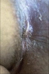 1. What is pictured here?
2. How is this diagnosed?
3. What is the treatment for it?