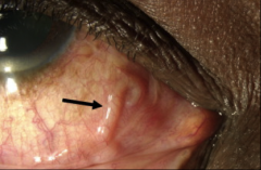 1. Loa Loa - Nematode, Roundworm

2. Western and Central Africa

3a. Infected fly bites you and injects the LARVAE
3d. Larva becomes ADULT and migrates to subconjunctiva (PICTURED)