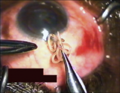 1. Loa Loa - Nematode, Roundworm

2a. Person returns from endemic area with local swellings.
2b. Visualization of adult worm beneath conjunctiva

3. Surgical Removal (Pictured)