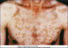 1. What disorder is pictured here and what causes it?

2. Describe the morphology of the infection.

3. Is this in yeast or hyphal form?

4. How long does this last and what are the symptoms associated with it?