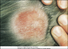 1. What causes Tinea Capitis?

2. What is the scope of the infection?

3. What is the most serious form of this infection? What does it look like?

4. What is the vector for this?