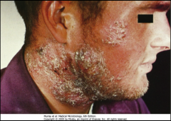 1. What causes Tinea Barbae?

2. What is the scope of the infection?

3. What happens if you shave with this?