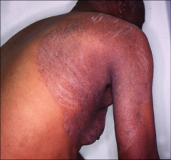 1. What causes Tinea Corporis?

2. What is the scope of the infection?

3. How is this spread?
