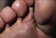 1. What causes Tinea Pedis?

2. What is another name for TInea Pedis?