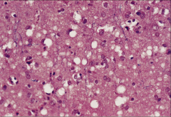 1. Small vacuoles within the Neuropil from neuronal loss followed by glial cell proliferation to fill in the gaps

2. No Inflammatory response

3a. Progressive neurodegeneration
3b. Unknown Incubation period
3c. Loss of muscle control and Tremors
3