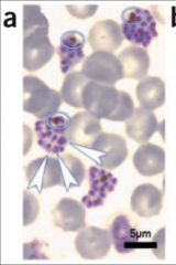 1. What pigment accumulates in the RBC infected with Plasmodium? What is it comprised of?

2. Why does Plasmodium break down Hb?

3. What part of Malaria causes Anemia?

4. What is are the white arrows in the picture pointing to?