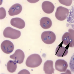 1. What are the black arrows pointing to? Why is this significant?

2. When you Giemsa stain a blood sample infected with this, what will you see?

3. What else will help you diagnose this?

4. How do you treat this?