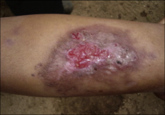 1. Which Leishmania species causes the pictured symptom?

2. What is distinctive about cutaneous Leishmaniasis?

3. What is the cause of the ulcers?

4. How is Cutaneous Leishmaniasis diagnosed?