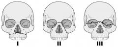 Midface fractures
I - only maxilla at level nasal fossa
II - maxilla, nasal bones, medial aspect orbit. MOST COMMON
III - separates midface from base of cranium, base of nose, ethmoids, across orbits, zygomatic arches

II AND III - may require urgent