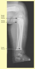 Proximal numeral or humeral shaft <3y
Fractures with shearing or distracting mechanism
Corner or bucket handle metaphyseal injuries see picture
Femoral fractures infants
Rib fractures 
Complex skull fractures
Multiple esp differently aged fractures