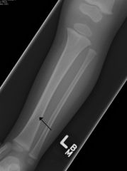 You see a child of 14 months with the following fracture. Describe it, and suggest the likelihood of NAI