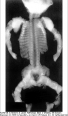 -radiograph of type 2 OI
*Type II OI – Fetal, Neonatal, Lethal