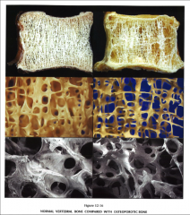 L: normal
R: osteoporosis 
*affects spongy bone more than cortical bone--hip fractures, vertebral bodies