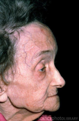 -poly-ostotic Paget Disease
-frontal thickening
