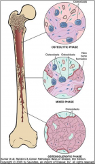 3 phases 
Osteolytic
Osteoclastic-osteoblastic with latter predominant
Osteosclerosis (burnt-out)