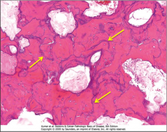 -Mosaic Pattern in Paget's disease.
-arrows point to basophilic cement lines