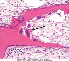 *Hyperparathyroidism – note osteoclasts dissecting a trabeculum. Note that osteoblast activity is also increased. The cortices will be thin and the dissections will produce a railroad track pattern on x-ray.
*Giant cells at arrow