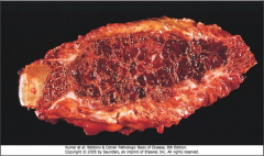 A brown tumor in a rib in a patient with hyperparathyroidism. These lesions can undergo cystic degeneration.