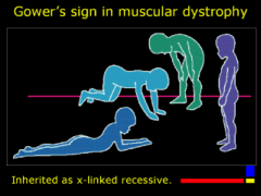 -Gower's sign
-Due to proximal m weakness