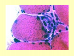 Invasion of intact fiber by lymphocytes- polymyositis