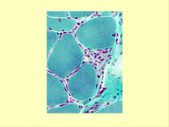 Necrotic muscle fiber (myophagocytosis) in polymyositis (trichrome stain)