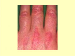 Skin rash- dermatomyositis
-don't ALWAYS see this