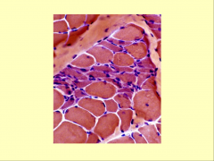 Focal muscle damage- dermatomyositis