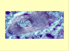 Inclusion bodies stained for beta-amyloid in Inclusion Body Myositis
