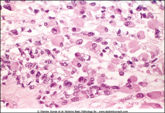 Rhabdomyosarcoma: The rhabdomyoblasts are large and round and have abundant eosinophilic cytoplasm; no cross-striations are evident here.