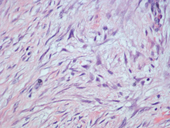 *note triangular fibroblast nucleus upper center
*background is myxoid, blue--a tipoff that this is NODULAR FASCIITIS